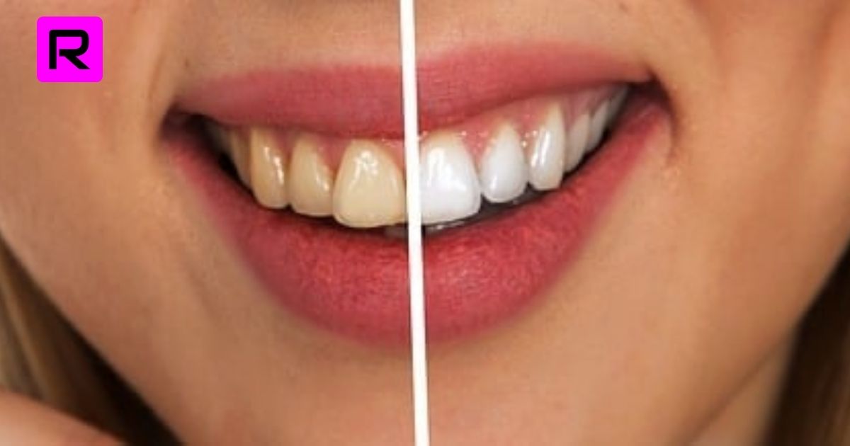 Yellow Teeth | White Teeth at Home | Healthy Teeth